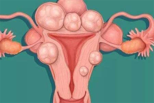 怀孕三个月查看出有子宫肌瘤