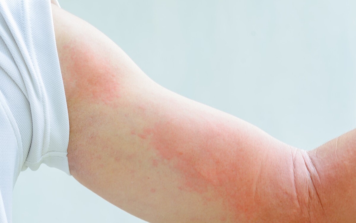 丘疹型荨麻疹，在儿童特别常见